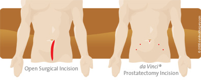 prostatectomy comparison