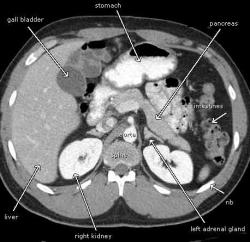 CT slice through the mid-abdomen showing multiple normal-appearing organs, which are labeled